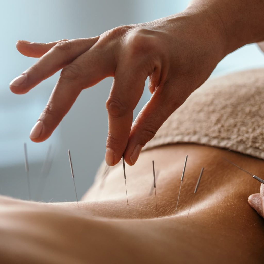 acupuncture-for-anxiety