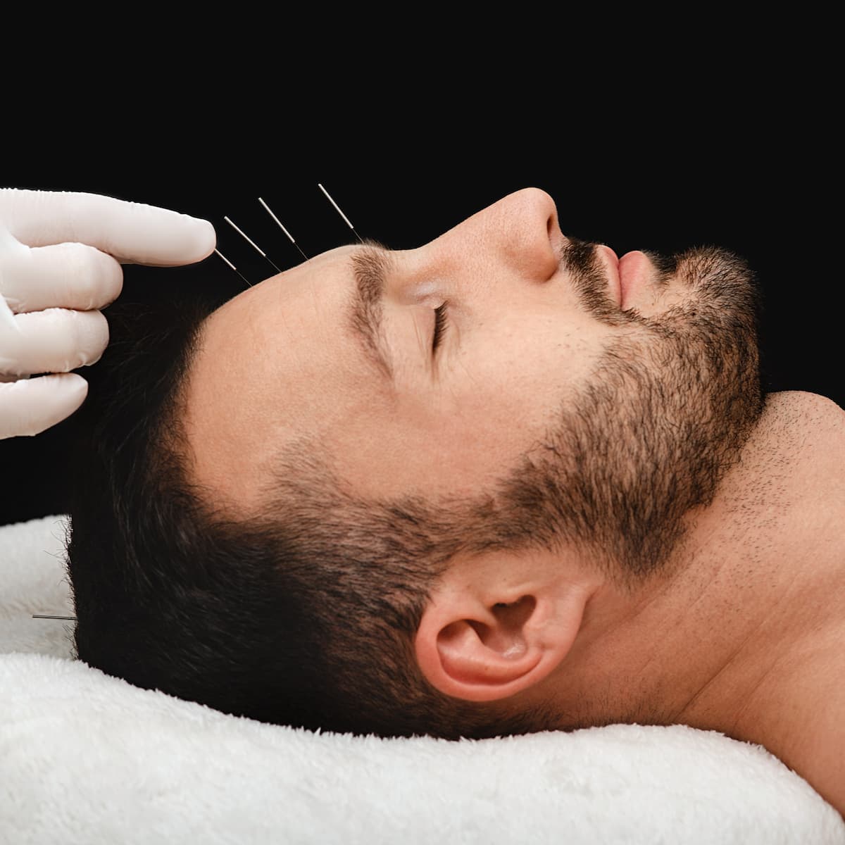 facial-acupuncture-bronx