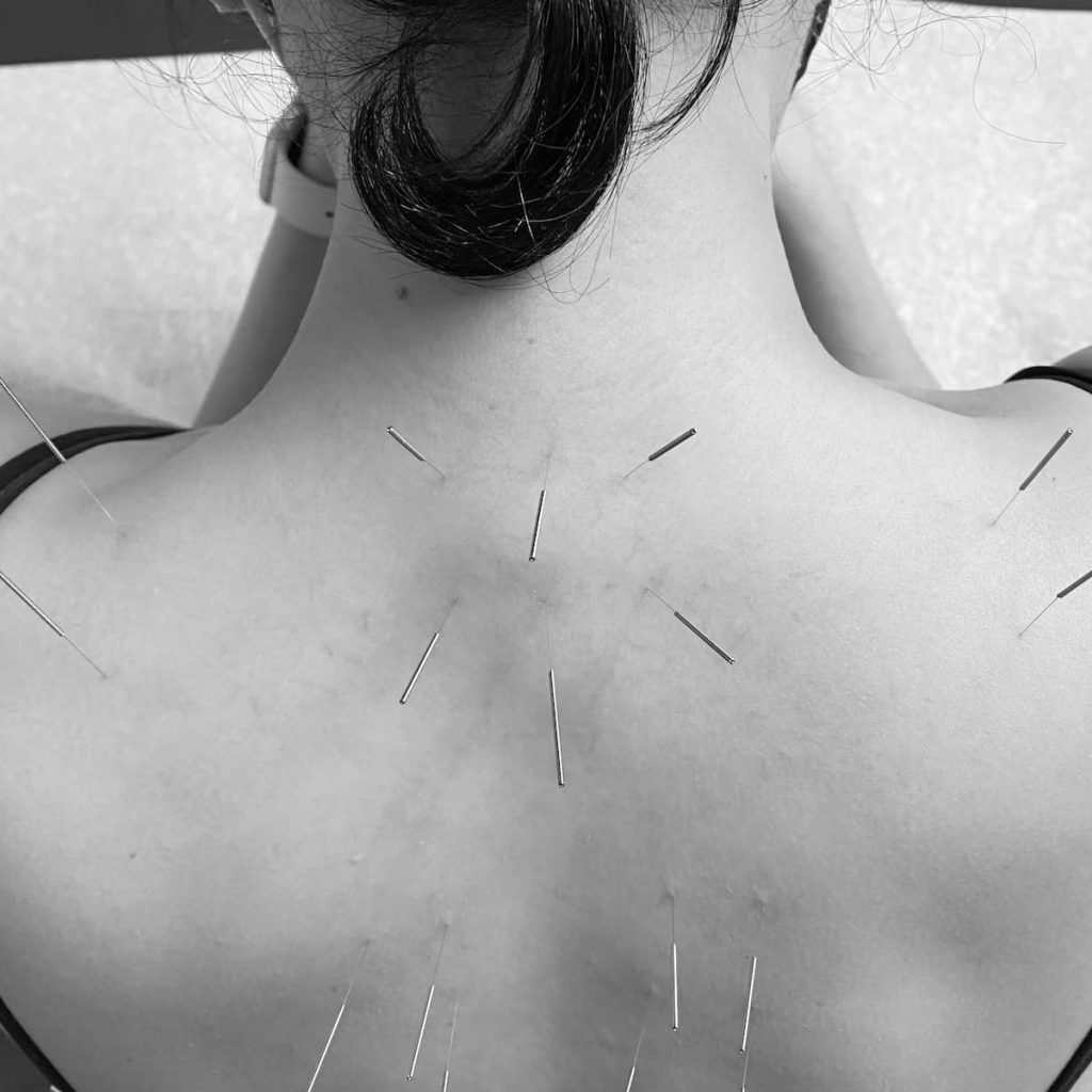 acupuncture-for-back-pain