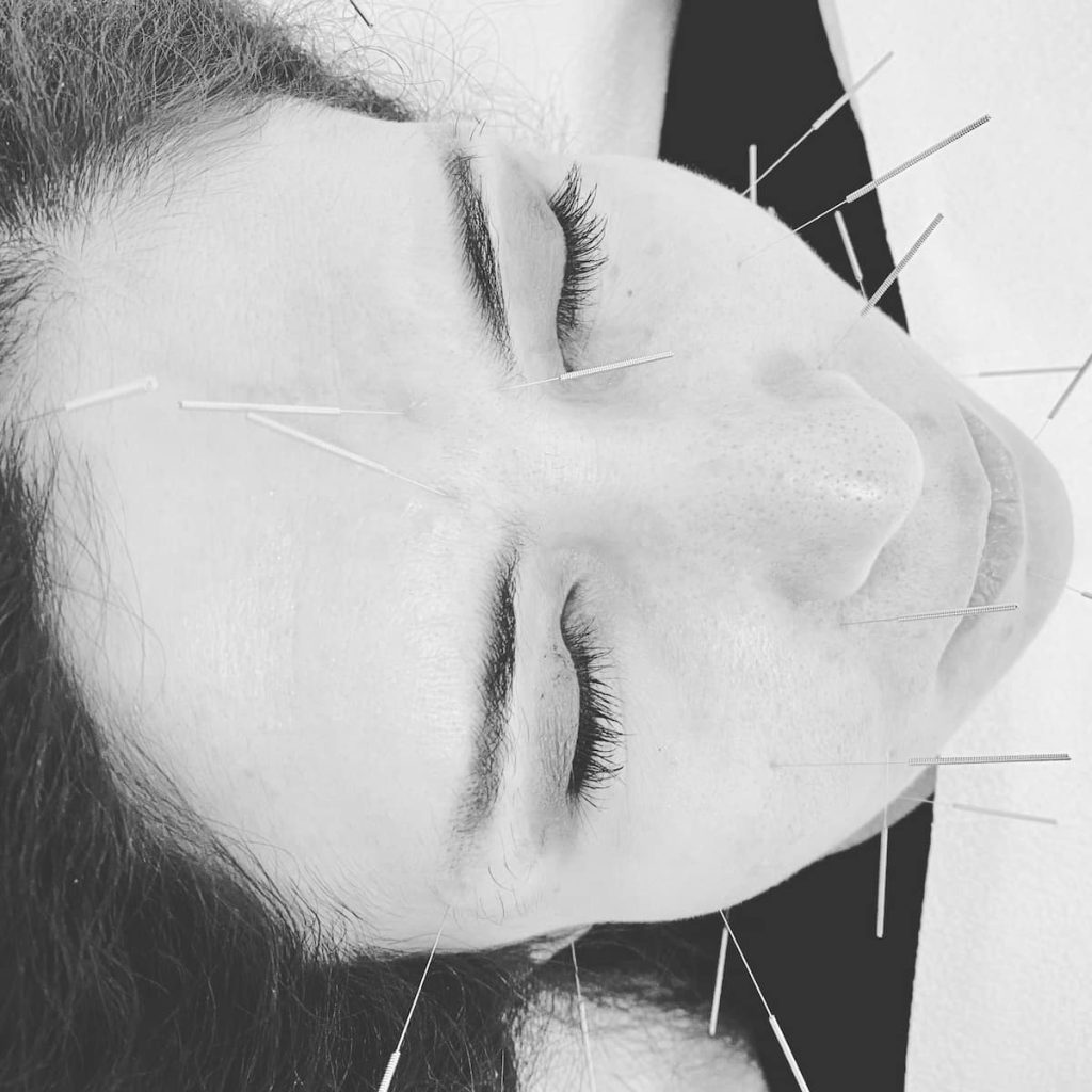nyc-facial-acupuncture