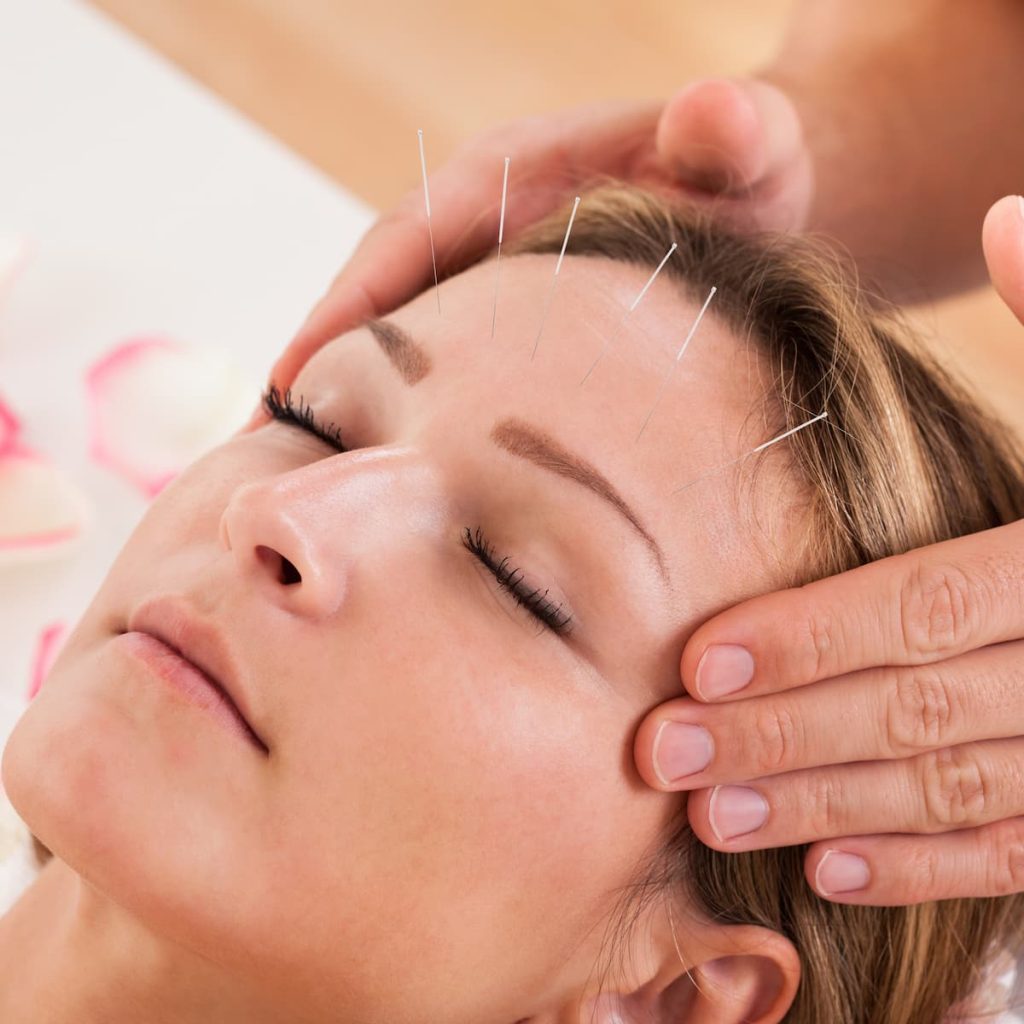 Acupuncture for Headache Body Mind Wellness Acupuncture
